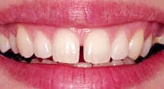 tampa teeth implants