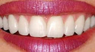 tampa teeth implants