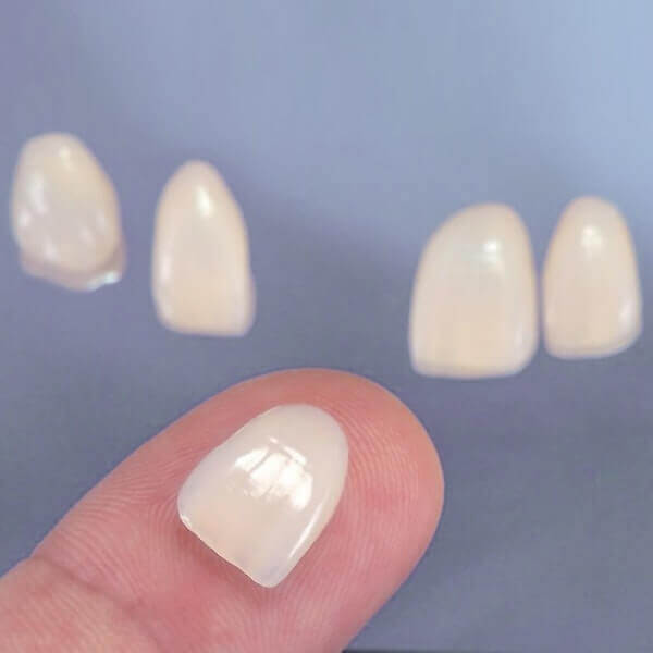 veneers7