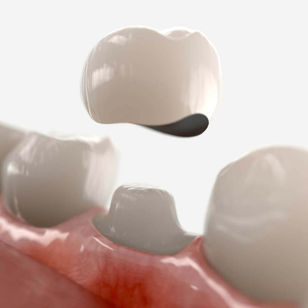 DentalCrown