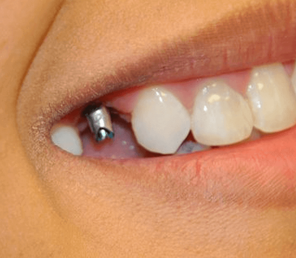 tooth extraction tampa