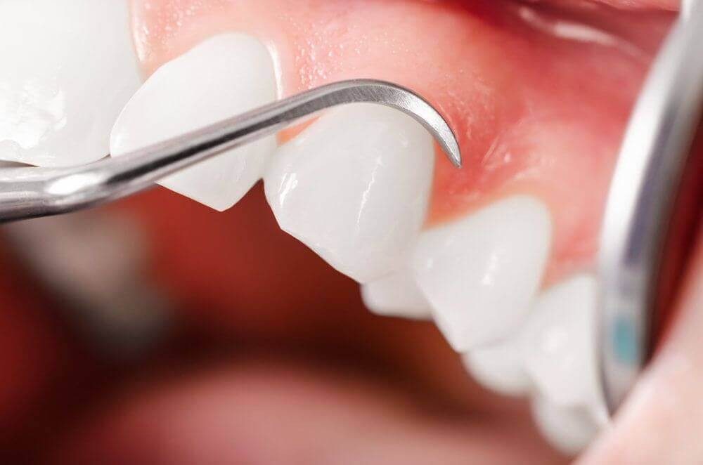 dental implants in tampa fl