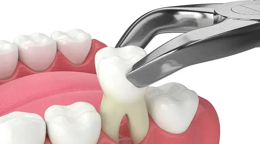 Tooth Extraction