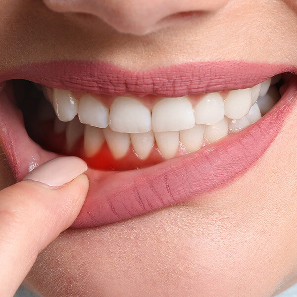 gumdisease2