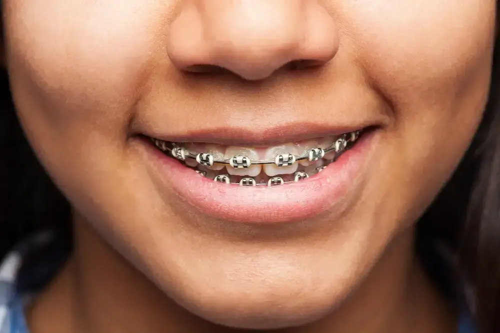 what are veneers what are veneers