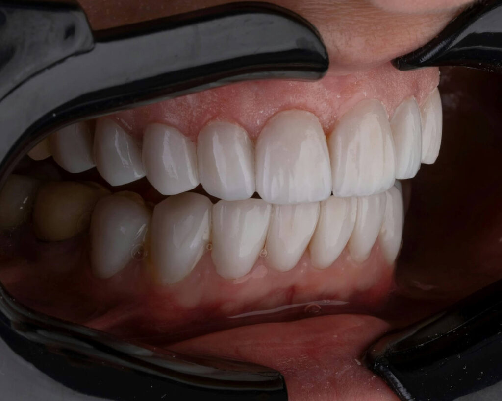 Avoiding junk sticky foods can prolong the life of tooth bonding procedures
