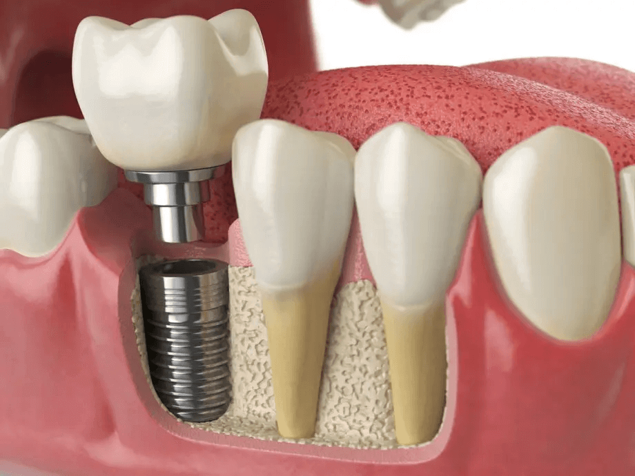 Dental Implants Process