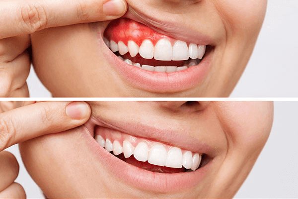 Healthy gums are achievable with professional oral care
