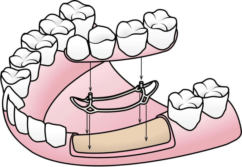 Subperiosteal Dental Implant