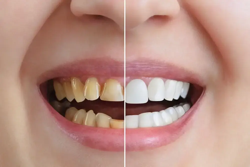 Teeth Bonding vs. Veneers Teeth Bonding vs. Veneers