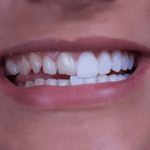 Teeth bonding helps fix small dental imperfections