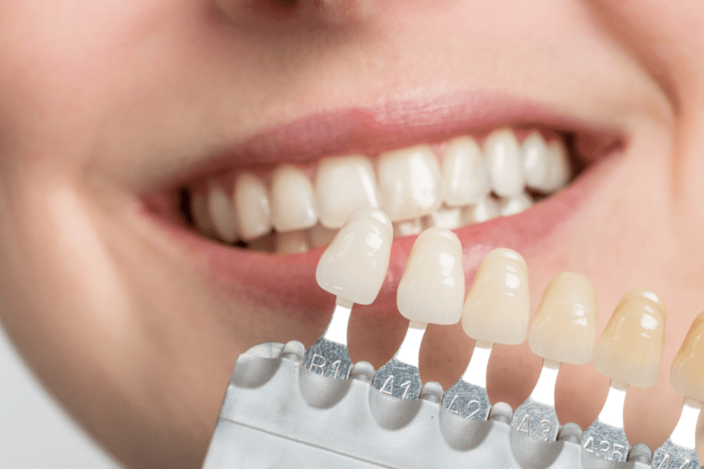 Veneers are a long-lasting treatment for fixing teeth