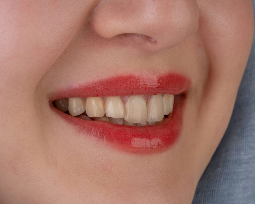 Veneers are made from tooth-colored materials