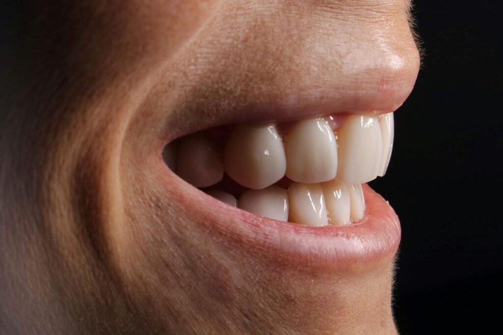 Veneers are resistant to damage from junk foods
