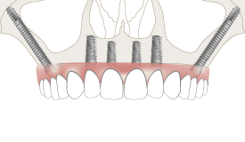Zygomatic Dental Implants