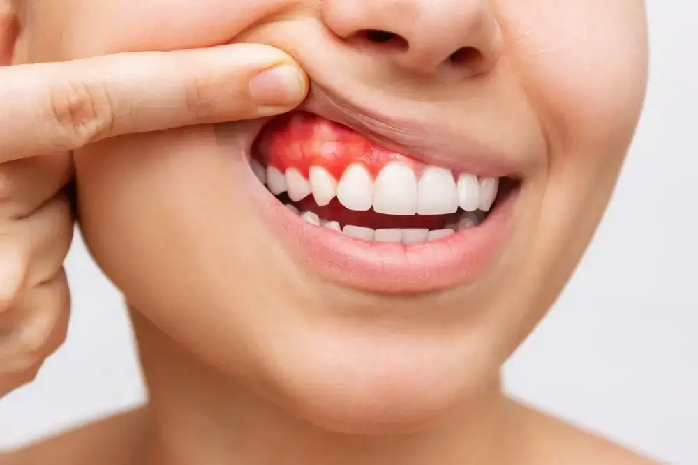 how to cure gum disease without a dentist