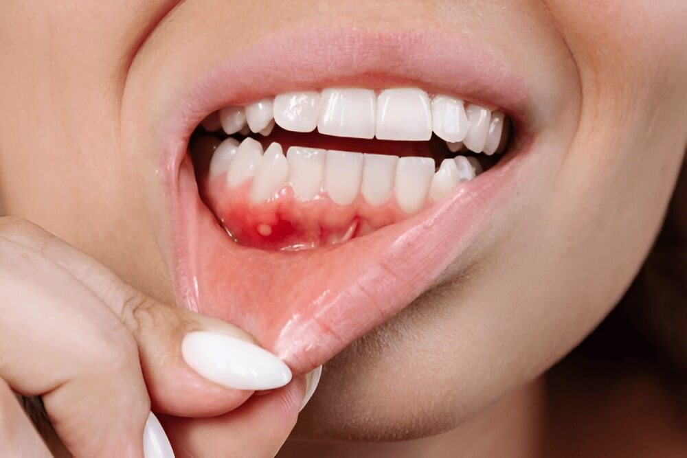 Are Gum Diseases Contagious