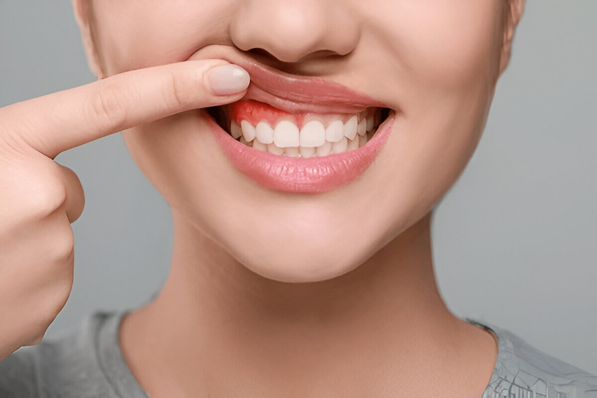 stages of gum disease stages of gum disease