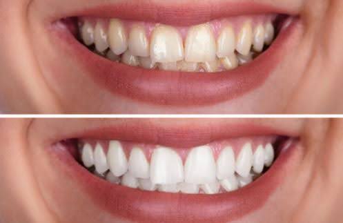 How to Restore Enamel on Teeth?