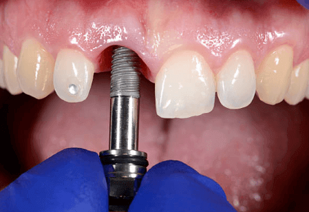 Dental Implants Versus Dentures: Which Choice Is Best?