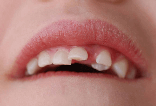 Cracked Tooth