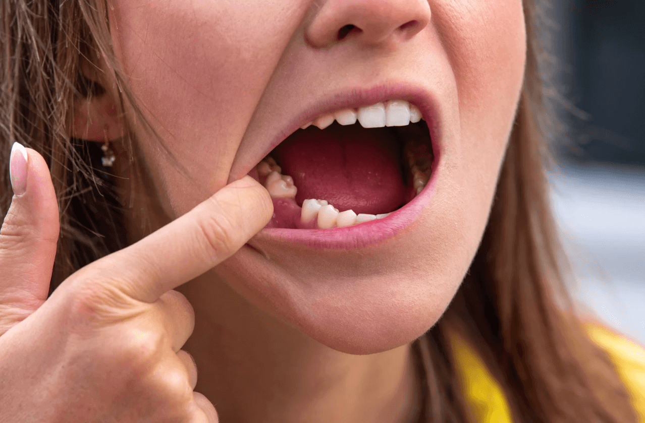 Tooth Extraction Tooth Extraction