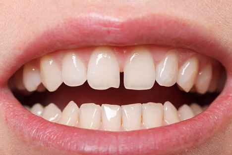 Full Mouth Reconstruction